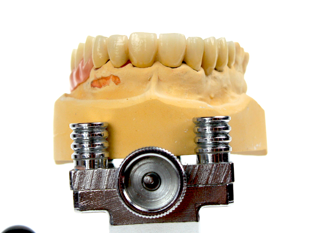 Der herausnehmbare Zahnersatz wird über spezielle – von außen unsichtbare – Verankerungselemente am Restgebiss befestigt.