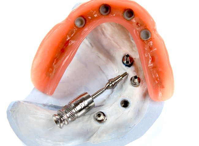 Vier auf Implantate aufgeschraubte Halteelemente. In die Prothese eingearbeitete Halteelemente klicken später über die konischen Aufbauten und sorgen für sicheren Halt der Prothese.