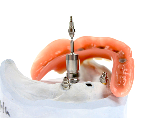 Vier auf Implantate aufgeschraubte Halteelemente. In die Prothese eingearbeitete Halteelemente klicken später über die konischen Aufbauten und sorgen für sicheren Halt der Prothese.