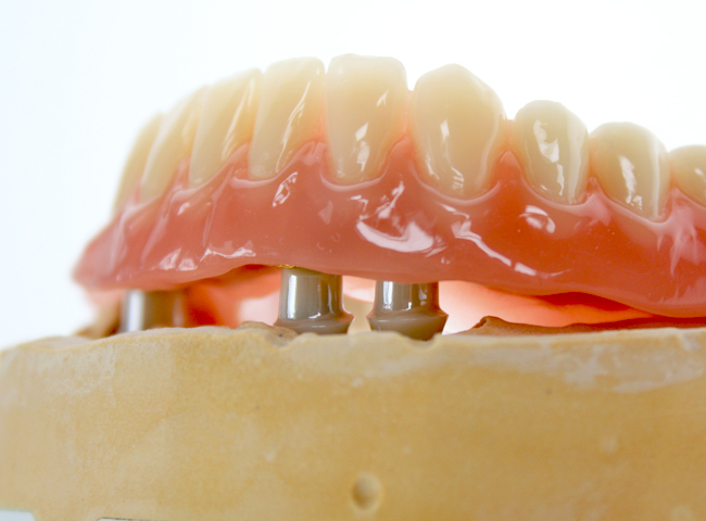 Zirkon bewirkt, dass der überkronte Zahn besonders natürlich wirkt.