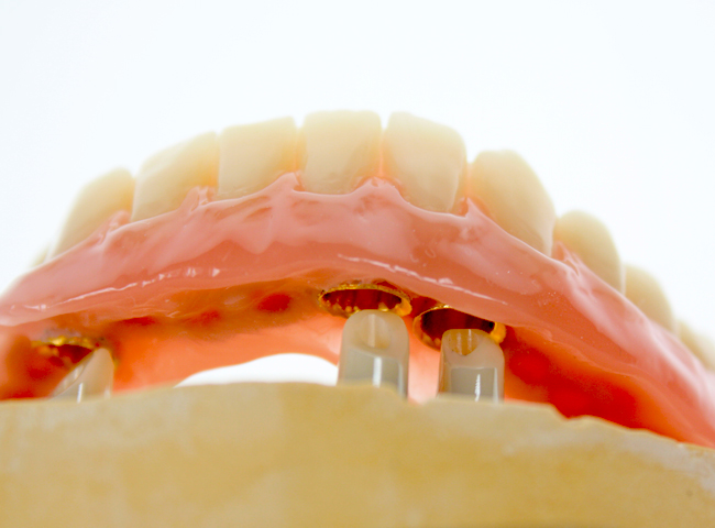 Zirkon bewirkt, dass der überkronte Zahn besonders natürlich wirkt.
