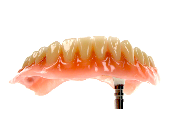 Die auf dem Zahn/Implantat angebrachte Krone besteht dabei aus zwei Teilen:<br>Einer Zirkonkrone und einen hauchdünnen Goldkappe.