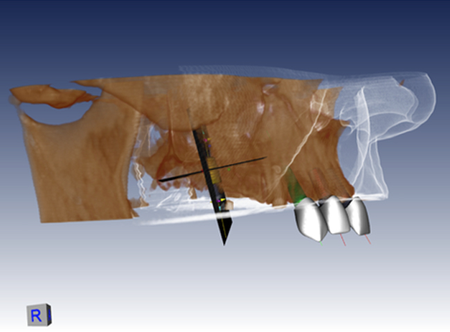 Knochenvolumenbild zur individuellen Planung der Implantatposition.